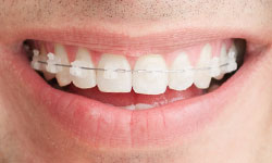 clear braces