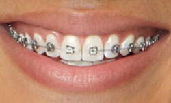 Types of Braces - Clearly Orthodontics | Toronto ON Types of Braces - Clearly Orthodontics | Toronto ON
